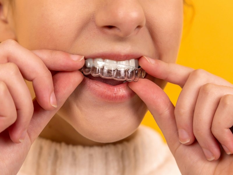 Paciente colocándose un alineador dental transparente